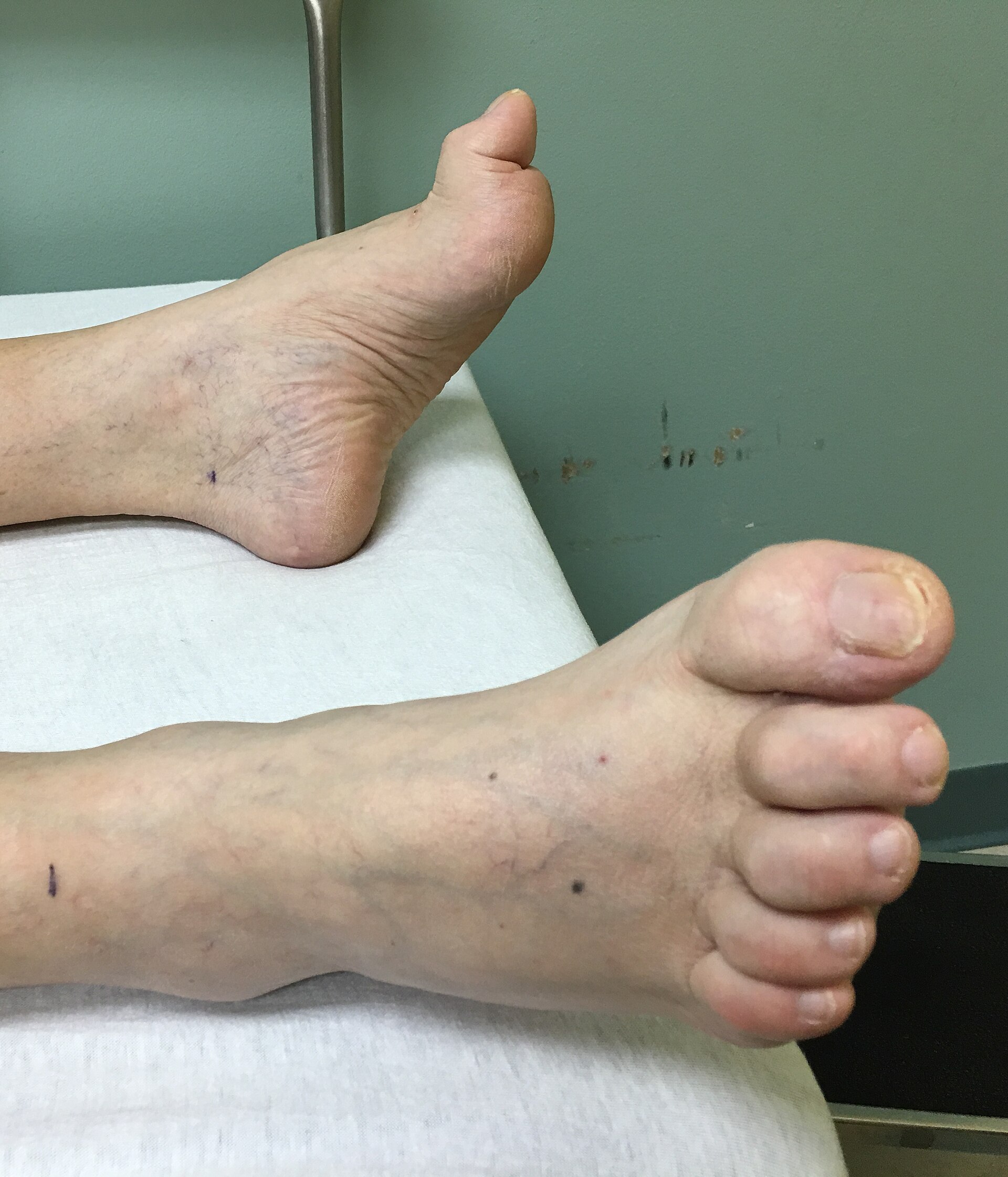 Hammertoes: Causes and Care Options Explained, related photograph
