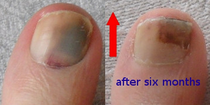 Onychomycosis (tinea unguium)