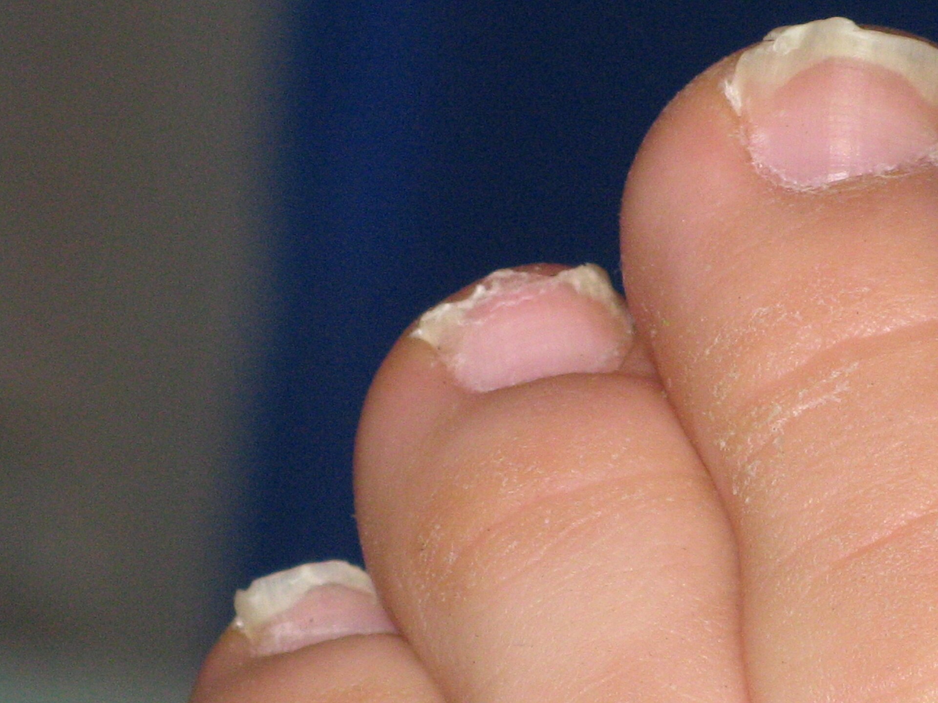 Left foot toenails of a c.20 year old male. The nails show damage to the free edge (white part of the nail). Toe nails
