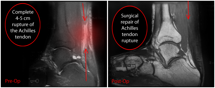 Achilles tendon repair with before and after imaging