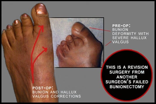 Before and after of a bunion and hallux valgus revision correcting a previous bunion surgery