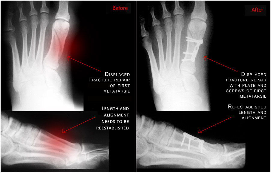 Metatarsal fracture repair case with before and after imaging