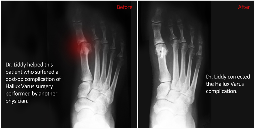 Hallux valgus correction case with before and after X-rays